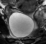 Cystic lesion