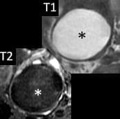 Endometrial  fluid †