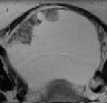 Cystic lesion with a solid* component