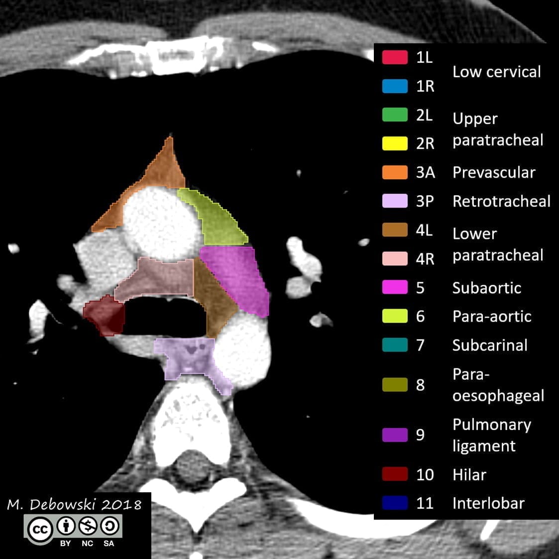 lymph nodes radiopaedia radaide