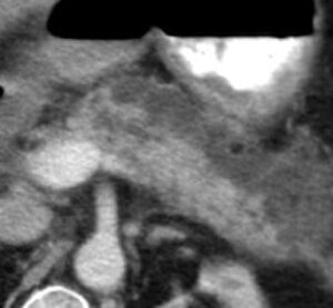 chemical shift adrenal mri calculator