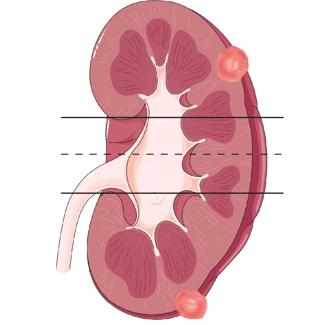 RENAL Score Calculator for Nephrometry - Rad At Hand