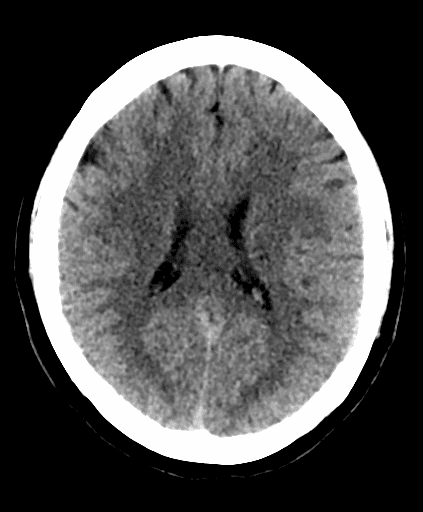 ASPECTS Score Calculator Rad At Hand
