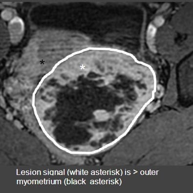 Greater than the outer myometrium