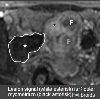 Less than or equal to the outer myometrium