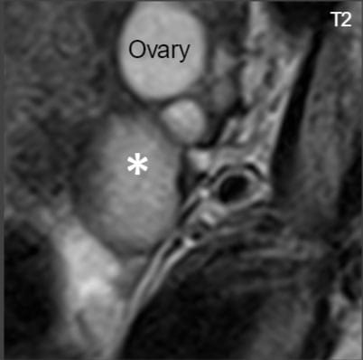 Para-ovarian cyst