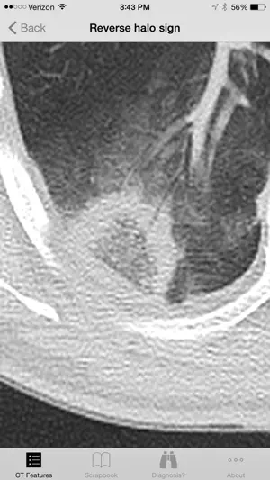 lung ct