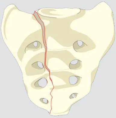 Central Fracture (involves spinal canal)