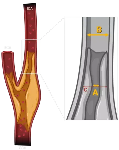 nascet calculator ecst carotid artery stenosis cta mra