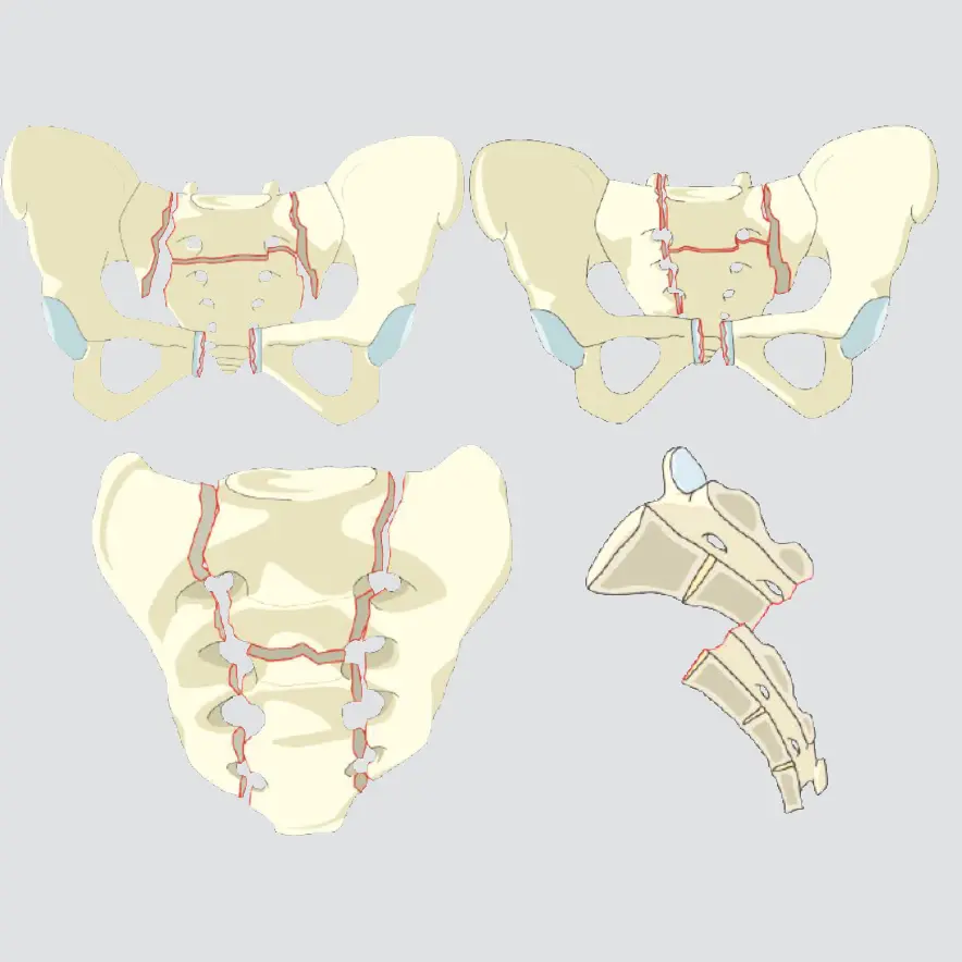 Displaced U-type sacral fracture