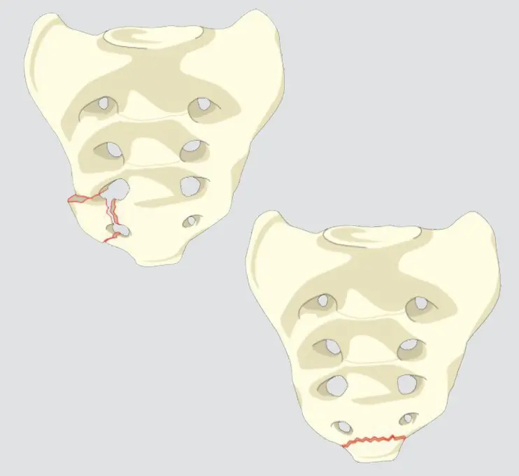 Coccygeal or compression vs ligamentous avulsion fractures