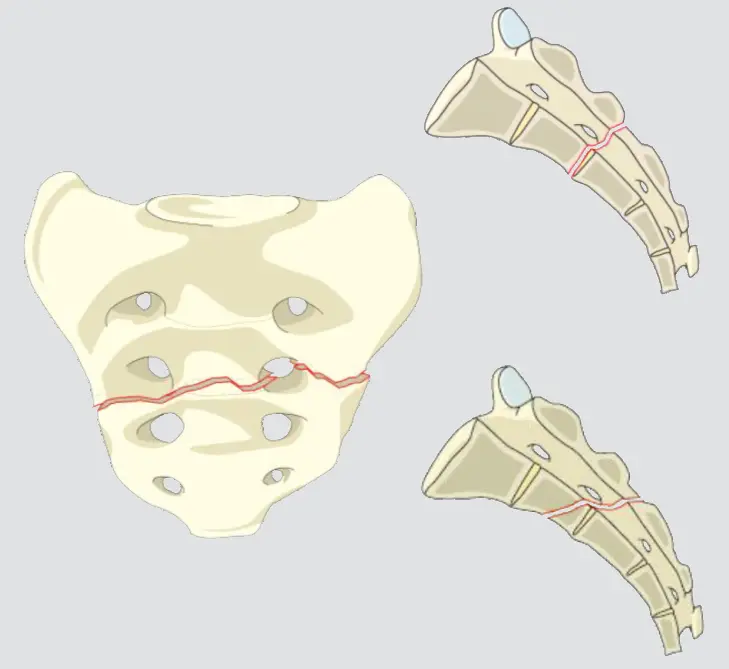 Non-displaced transverse fractures below the S-I joint