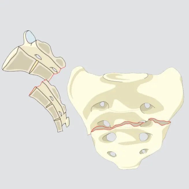 Displaced transverse fractures below the S-I joint