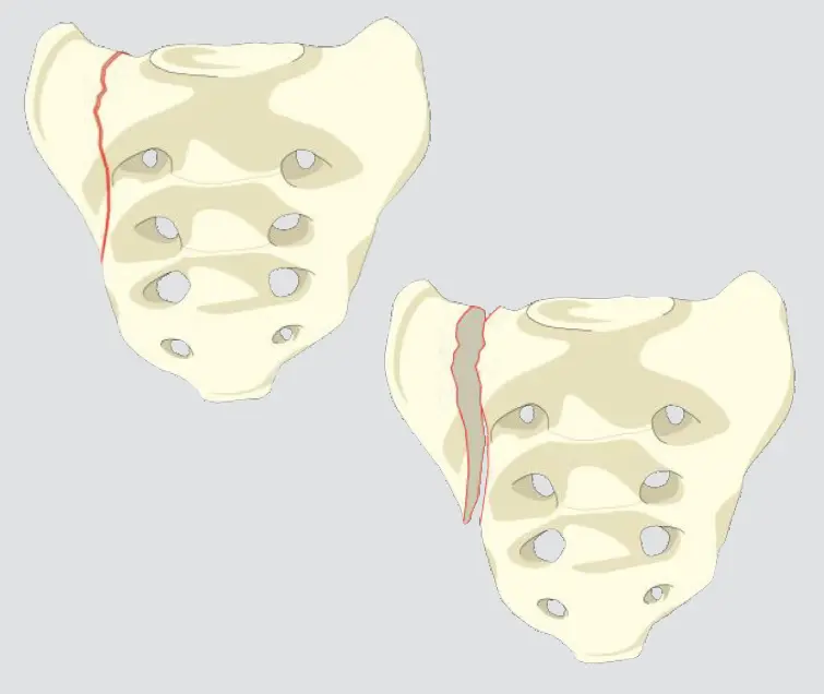 Transalar Fracture (does not involve foramina or spinal canal)