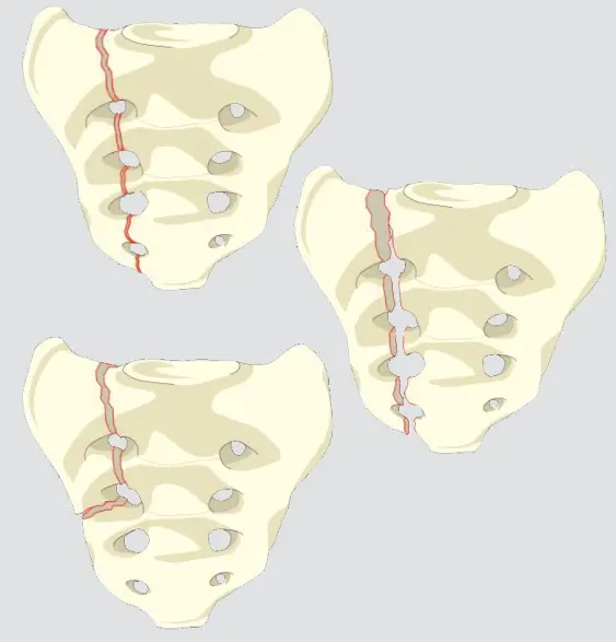 Transforaminal Fracture (involves foramina but not spinal canal)