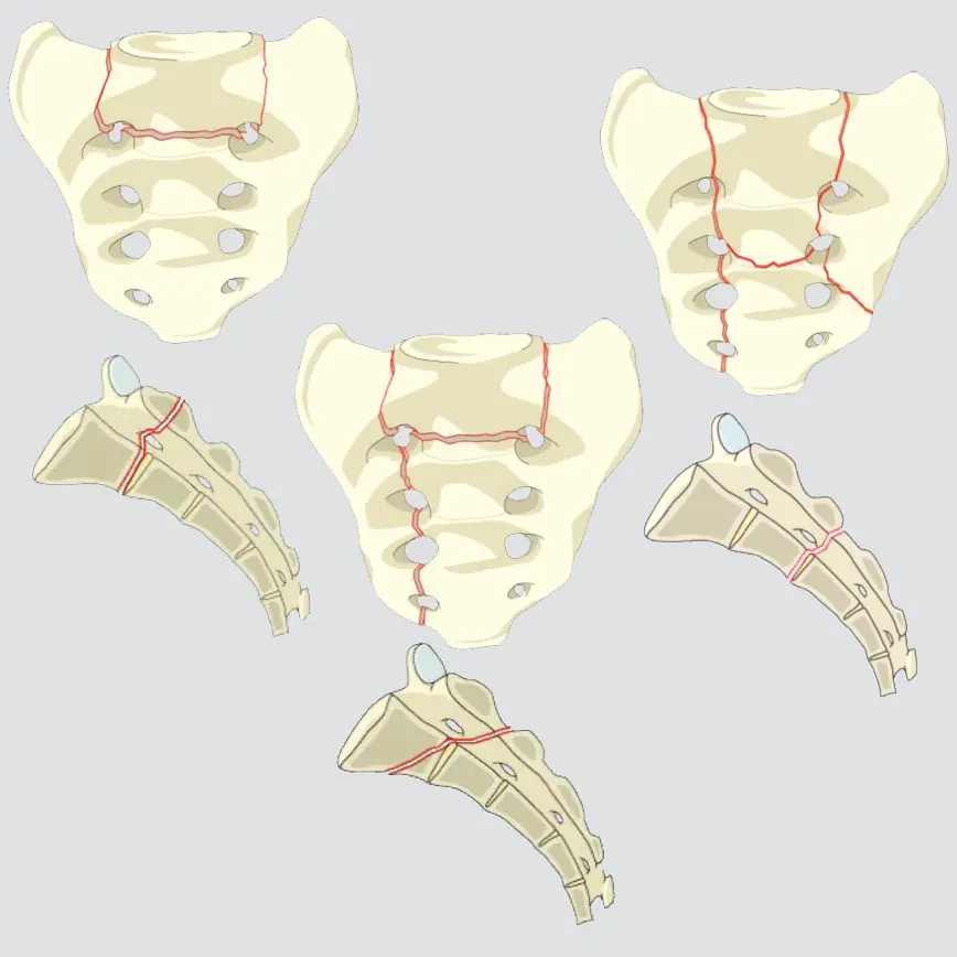 Nondisplaced sacral U-type variant