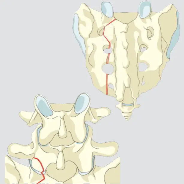 Sacral U-type variant without posterior pelvic instability