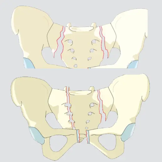 Bilateral vertical fractures without transverse fracture