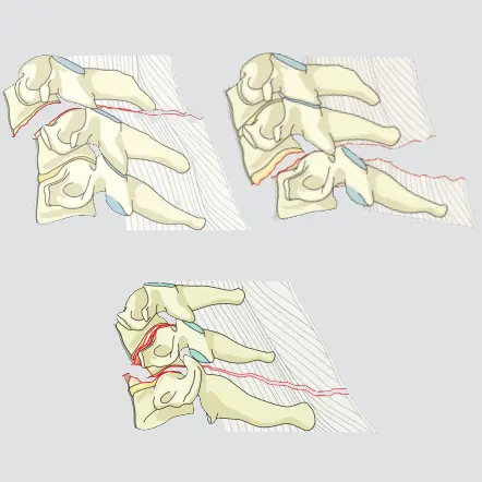 Pathologic subluxation or perched/dislocated facet