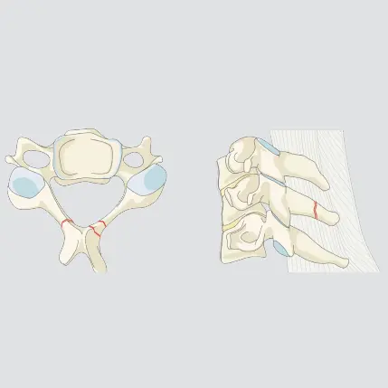 Minor, nonstructural fractures (e.g. isolated lamina or spinous process fractures)