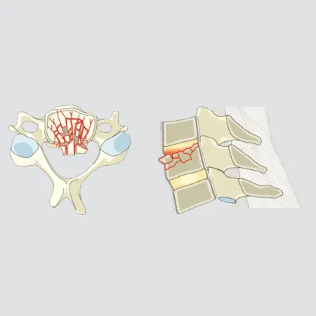 Incomplete burst fracture, involving a single endplate with involvement of the posterior vertebral wall