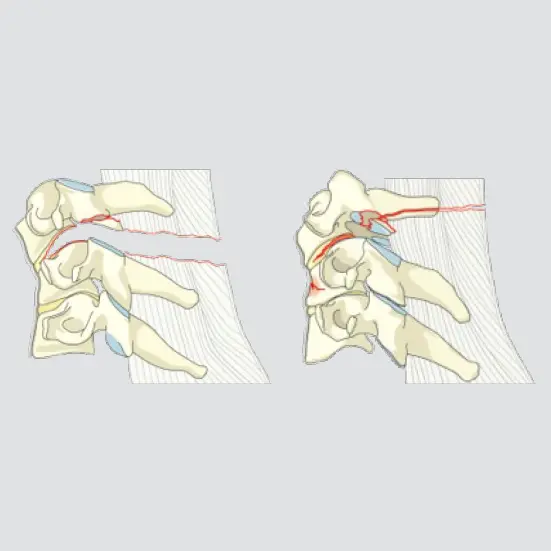 Posterior tension band <strong>ligamentous +/- bony</strong> injury (Disruption of capsuloligamentous structures together with a vertebral body, disc, and/or facet injury)