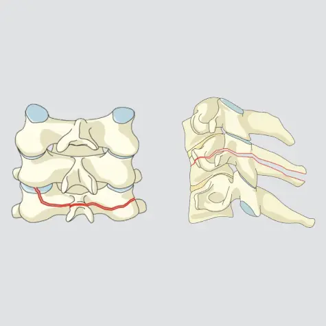 Posterior tension band <strong>bony</strong> injury (Physical separation through fractured bony structures only)