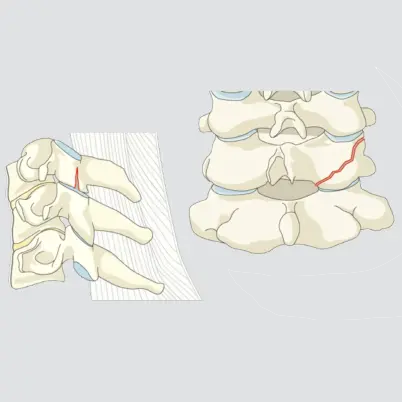 Nondisplaced facet fracture, < 1 cm in height and < 40% of the lateral mass