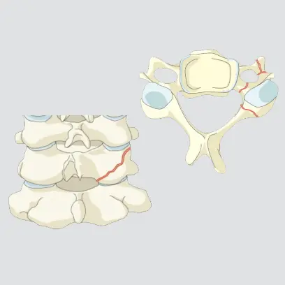 Floating lateral mass