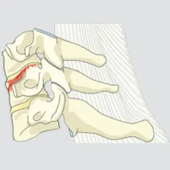 Wedge-compression (involving a single endplate without involvement of the posterior wall)