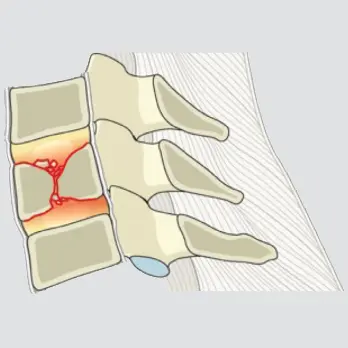 Coronal split or pincer fracture involving both endplates without involvement of the posterior wall