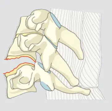 Anterior tension band injury (Physical disruption of bone/disc with tethering of the posterior elements)