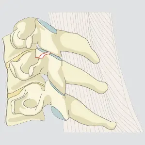 Facet fracture, displaced, >1 cm in height, or >40% of the lateral mass