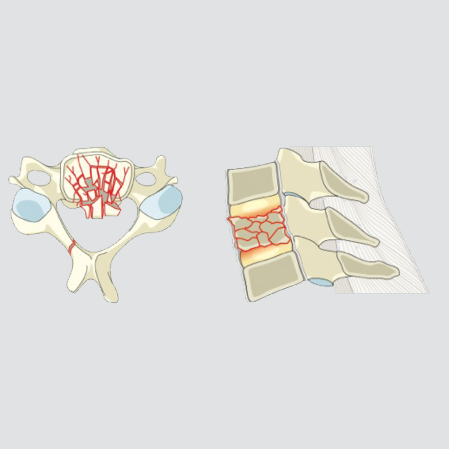 Complete burst fracture or sagittal split (involving both endplates)