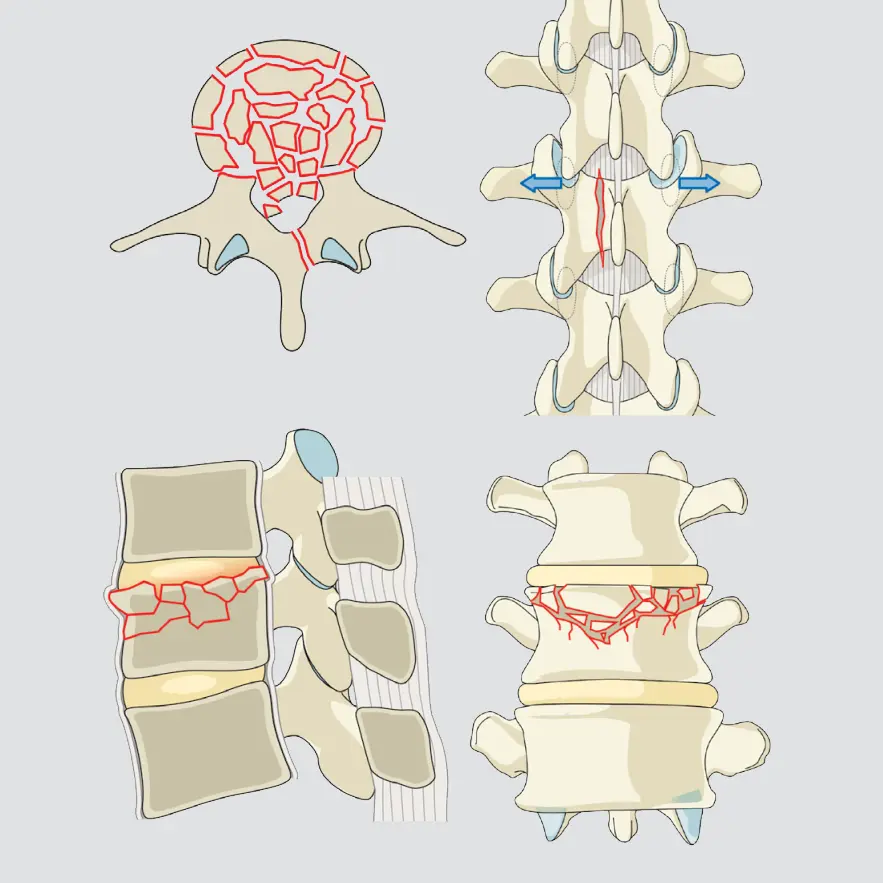 Incomplete burst (single endplate + posterior wall)