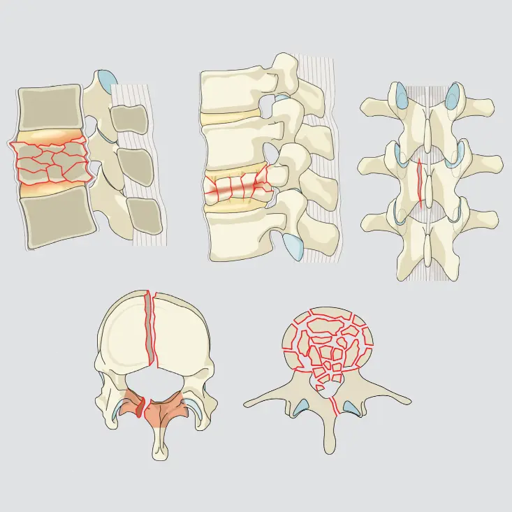 Complete burst (both endplates + posterior wall)