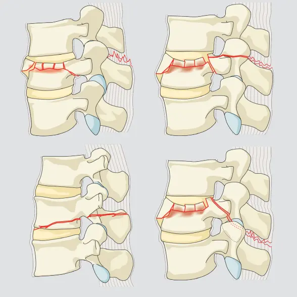 Posterior tension band disrutpion