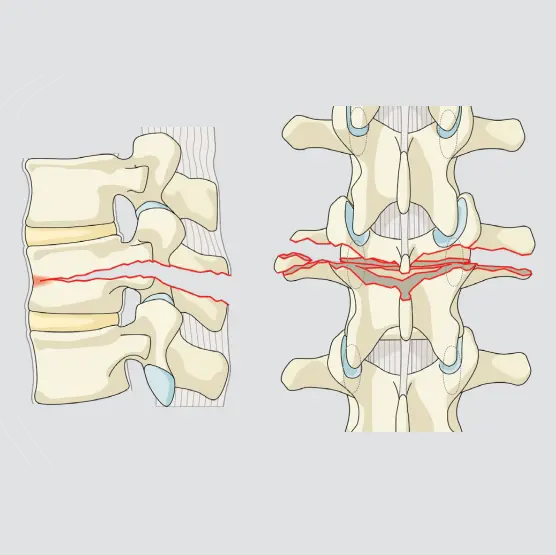 Chance fracture (transosseous tension band disruption)