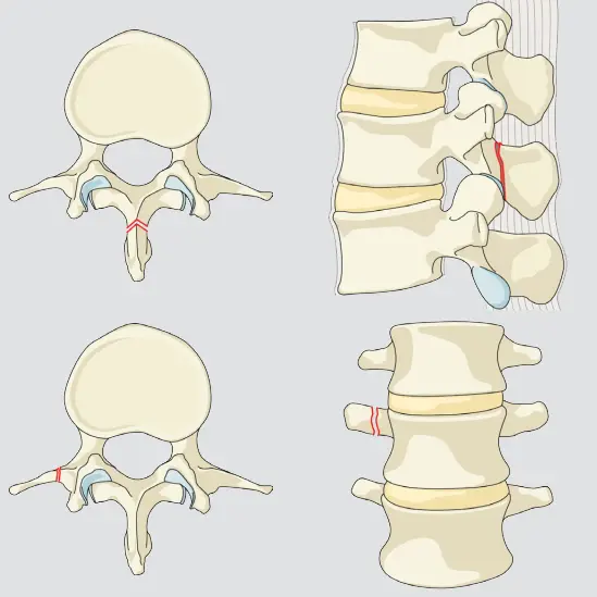 Minor, nonstructural fractures (i.e. not compromising the structural integrity of the spinal column)