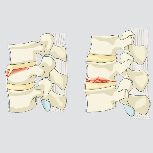 Wedge-compression (a single endplate, sparing the posterior wall)