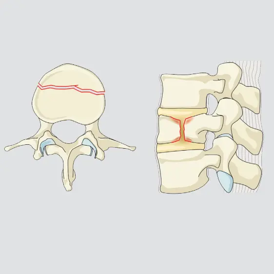 Split (both endplates, sparing the posterior wall)