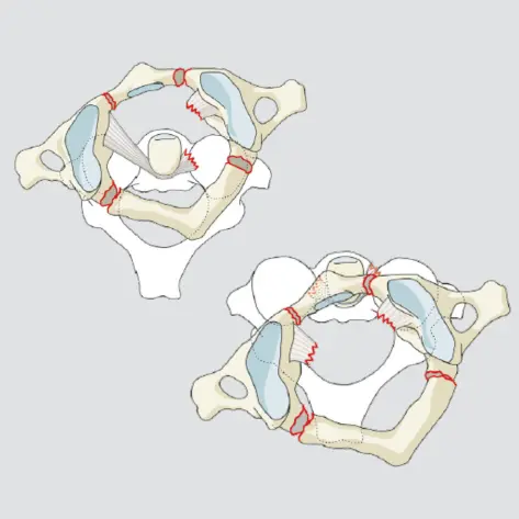 Atlantoaxial instability/translation