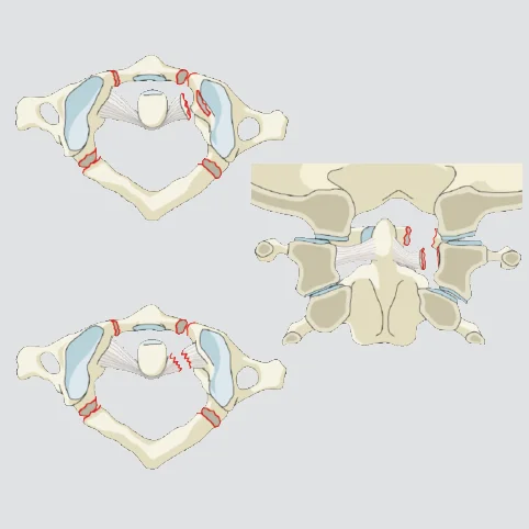 C1-C2 Ligamentous injury (+/- bony injury)