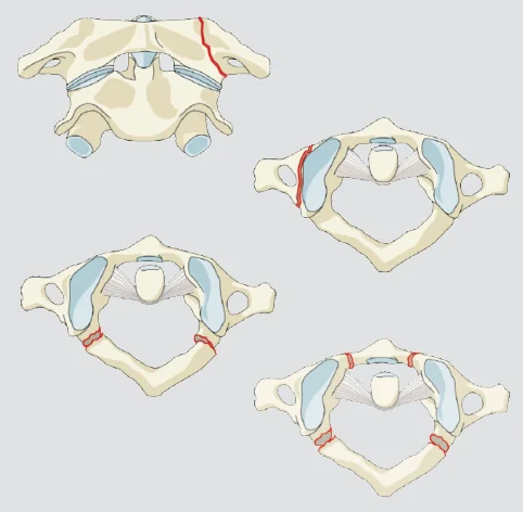 Isolated C1 Arch fracture