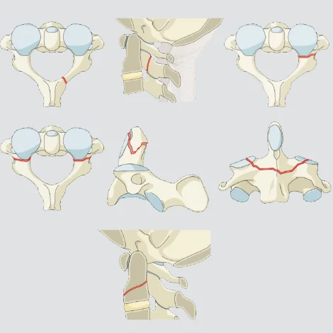 C2 fracture without ligamentous, tension band, discal injury