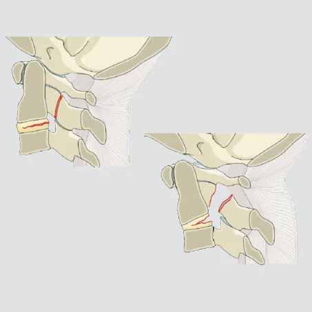 C2-C3 Tension band / Ligamentous injury (+/- bony injury)