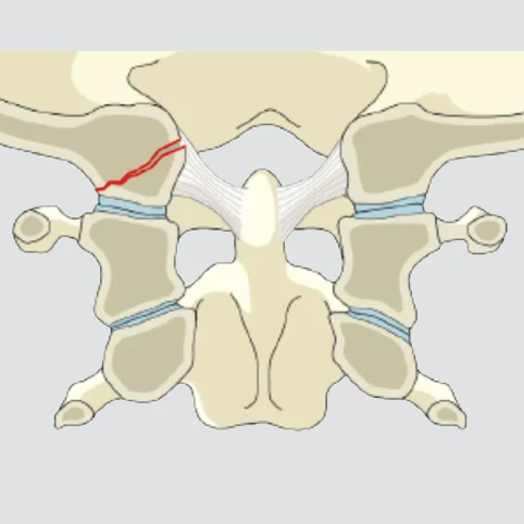 Isolated condyle fracture