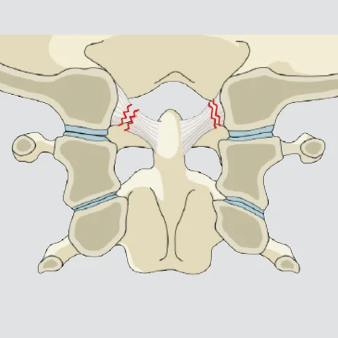 Craniocervical ligamentous injury (Nondisplaced, +/- bony injury)