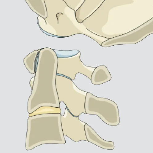 Craniocervical dissociation