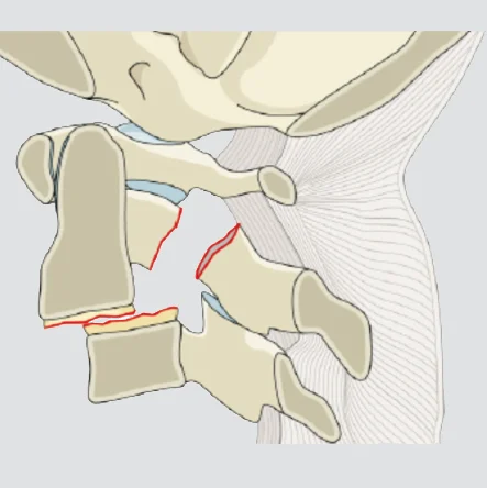 Translation of C2 vertebral body (in any plane)